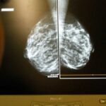 Mammograms-Explainer